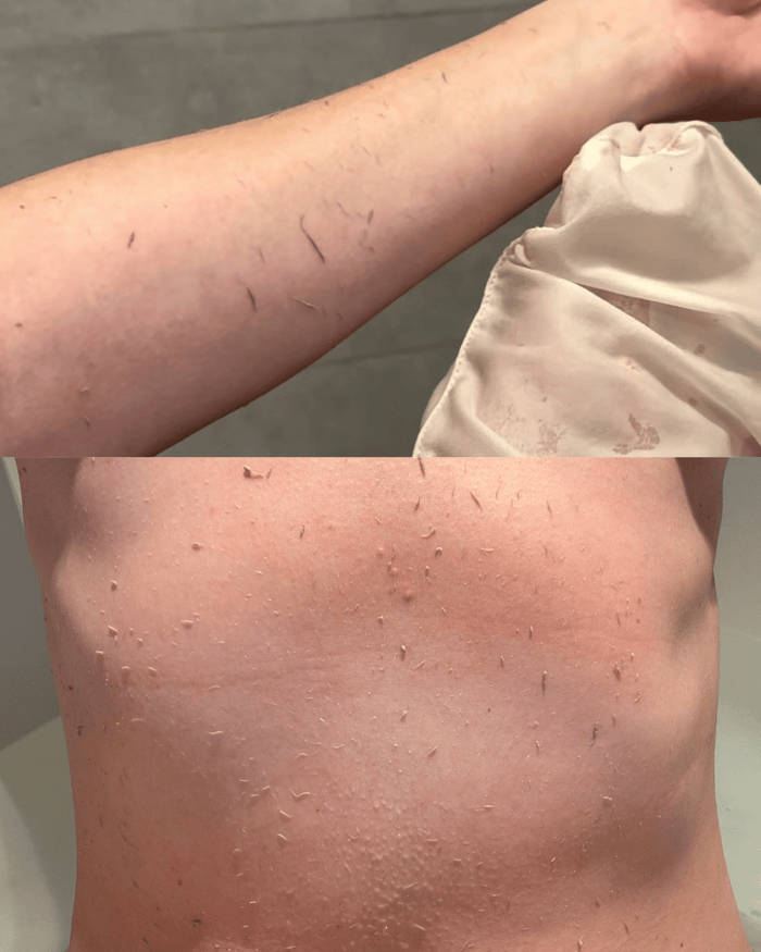 Dead Skin Build-Up