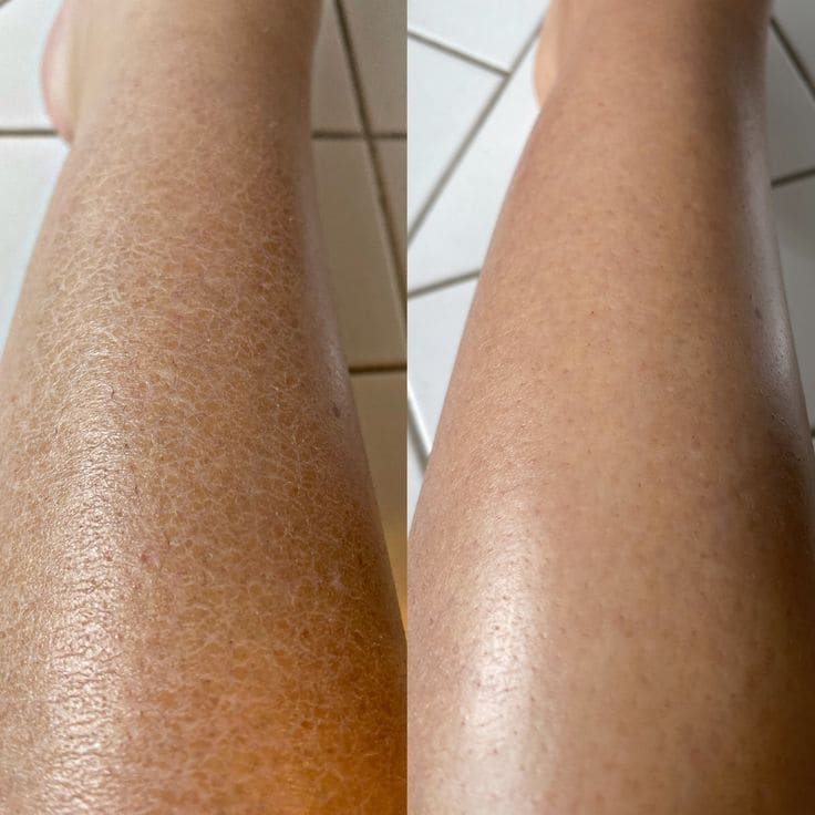 DRY SKIN