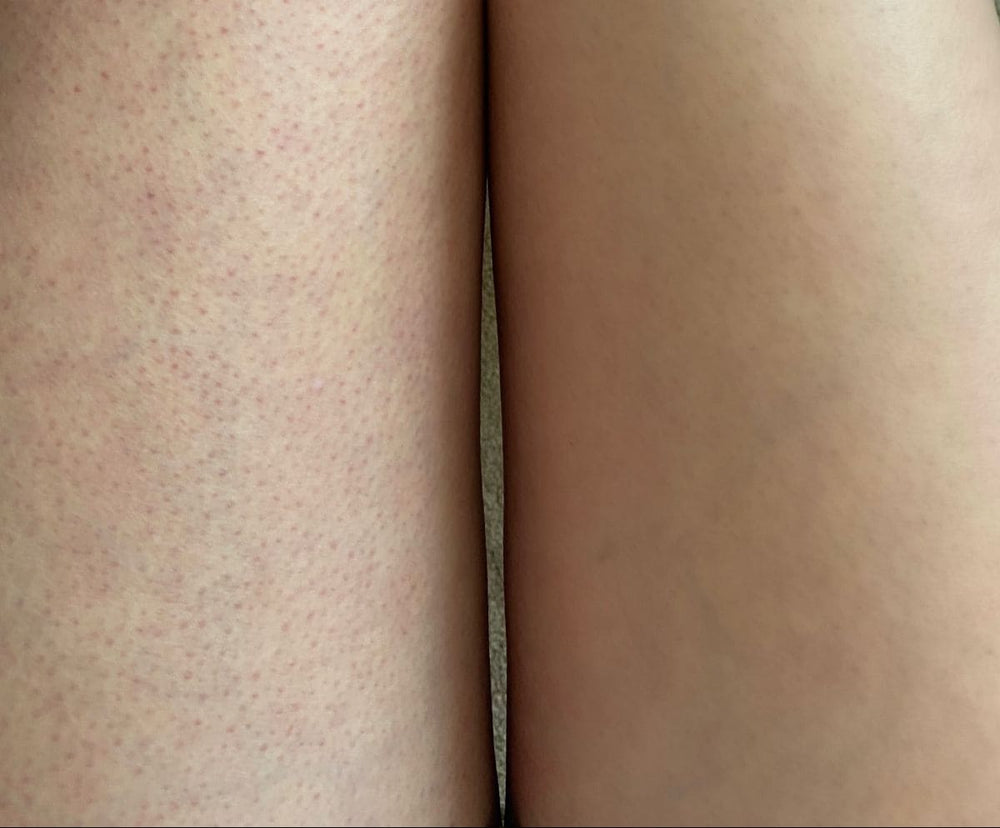 Keratosis Pilaris