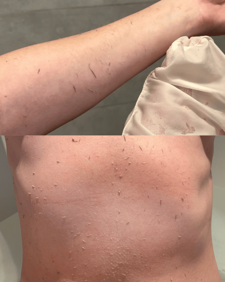 Dead Skin Build-Up