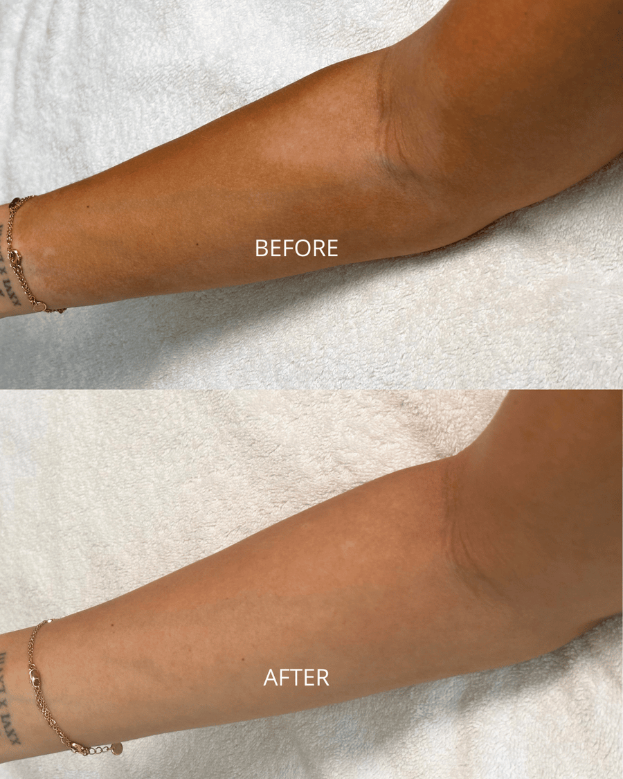 Self-Tan Patchiness