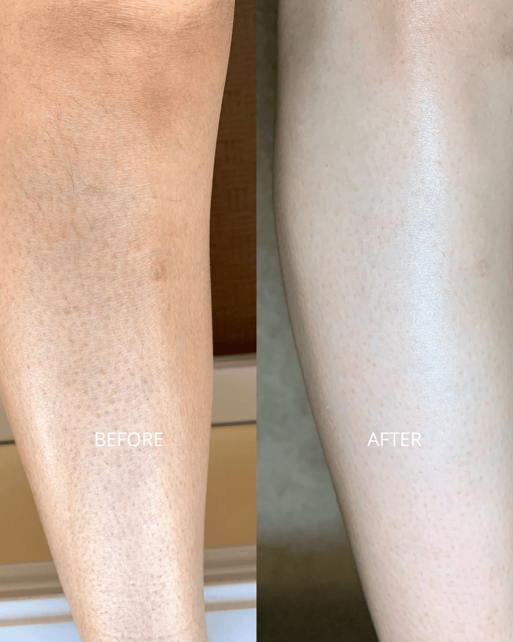 keratosis pilaris